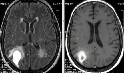 MRI експерт MRI при диагностицирането на мозъчно-съдови събития