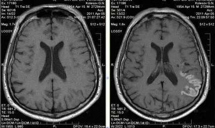 MRI szakértő MRI diagnózisának cerebrovascularis események