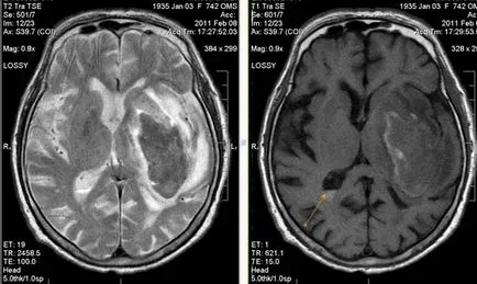 MRI експерт MRI при диагностицирането на мозъчно-съдови събития