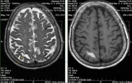 MRI експерт MRI при диагностицирането на мозъчно-съдови събития