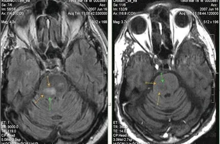 MRI експерт MRI при диагностицирането на мозъчно-съдови събития