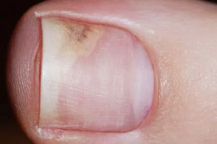 В началния етап на гъбички на ноктите на краката и ръцете на симптоми, лечение и снимки