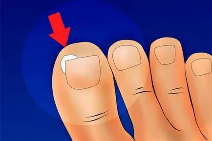 Etapa inițială a unghiilor ciuperca pe picioare și mâinile simptome, tratament și fotografii