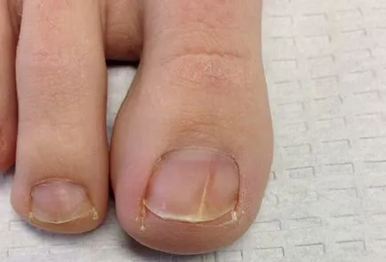В началния етап на гъбички на ноктите на краката и ръцете на симптоми, лечение и снимки