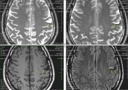 MRI експерт MRI при диагностицирането на мозъчно-съдови събития