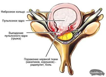 Este posibil să se facă masaj cu hernie vertebrala cum se