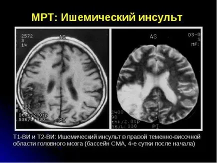 MRI в видове инсулт, които ще се обучават