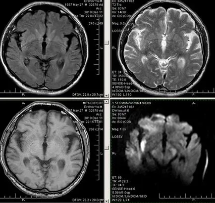 MRI експерт MRI при диагностицирането на мозъчно-съдови събития