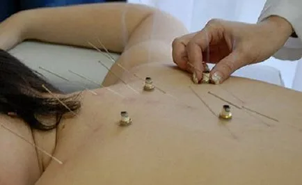 Tratament alternativ pentru astm acupunctura