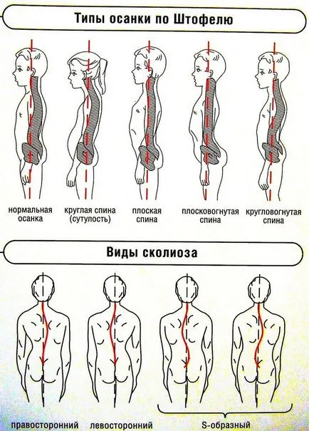 В резултат на неправилната стойка, се случи, последствията, симптомите и видове