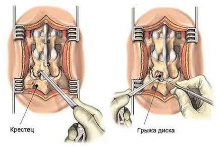 Операция гръбначния херния на показанията на лумбални и ефектите на четене