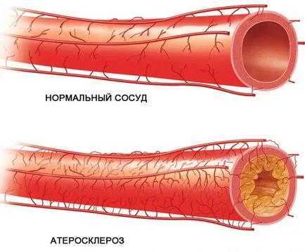 extremitatea inferioara cauzele ocluziei arteriale, simptome, tratament si prevenire