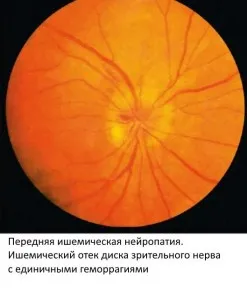 Optic Neuropatia simptome apariție și tratament