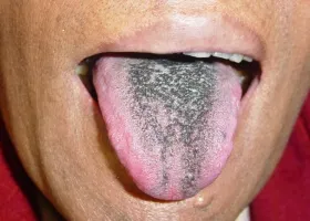 Основни орални заболявания и профилактика на устната кухина