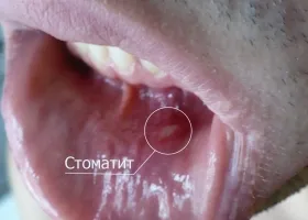 Основни орални заболявания и профилактика на устната кухина