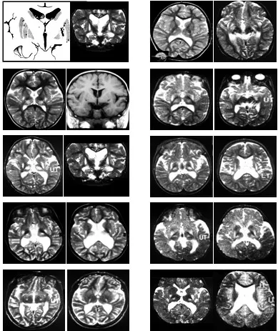 Tartalmaz egy nyitott MRI az agy