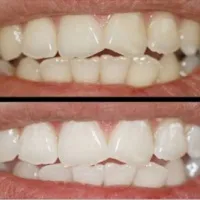 Избелване на зъбите преди сватбата 2