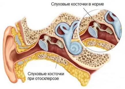 Отосклероза симптоми, диагностика, лечение (хирургия)