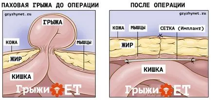 Ингвинална херния видове и съвременни методи на лечение