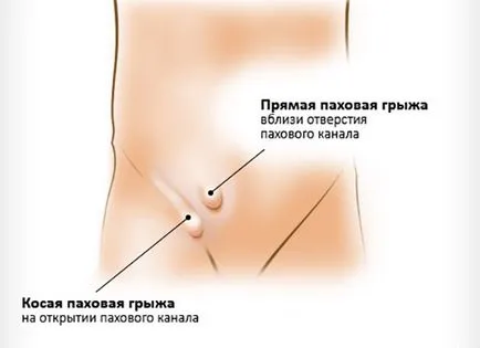 Ингвинална херния видове и съвременни методи на лечение