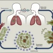 tuberculoza primară, care este, complicații și forme