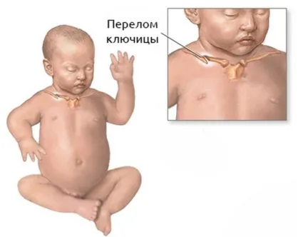prejudiciu fractura de clavicula in caracteristici nou-nascuti
