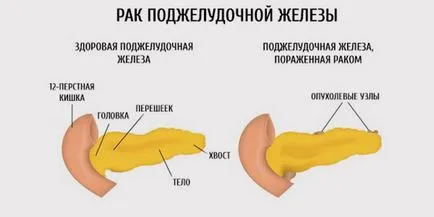 Primele simptome de simptome de cancer pancreatic si diagnostic