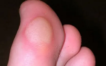Patch-uri de vezicule pe degetele de la picioare cele mai bune branduri (Urgo, leiko etc.