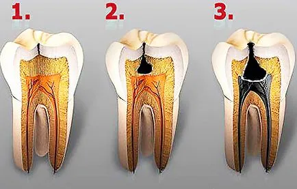 Miért kell kezelni a fogszuvasodás - Dental portálon go-fogorvos (orvosok és klinikák számára ajánlások)