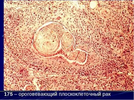 Keratinizing плоскоклетъчен карцином на ларинкса, на простатата и шийката