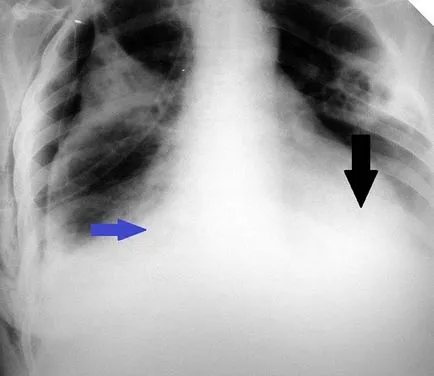 Pleurezia de cancer pulmonar la