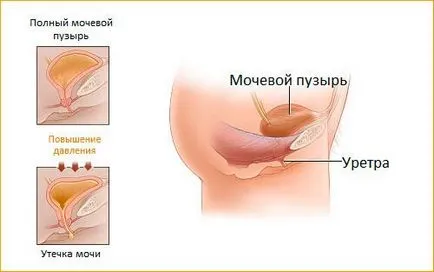 Урината изтичане на жените Симптоми, причини и лечение