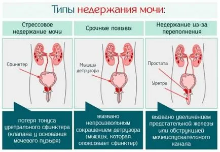 Urina de scurgere la femei Simptome, cauze si tratament