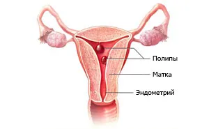 Méhnyálkahártya polip okai, tünetei és kezelése