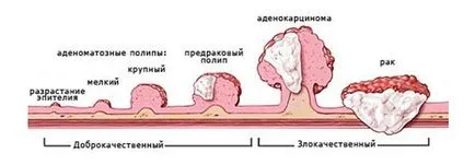 Polip 12 duodenum, kezelés Budapest