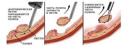 Polip 12 nyombélfekély tünetek és a kezelés