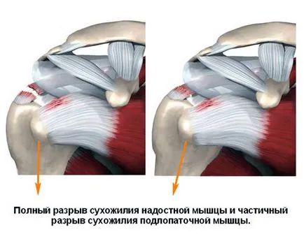 Teljes szakadás ín a supraspinatus izom és a részleges szakadás az ín a lapocka alatti izom, Gu