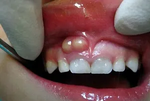 След отстраняване на зъба се появява бум на венците защо се образува твърд