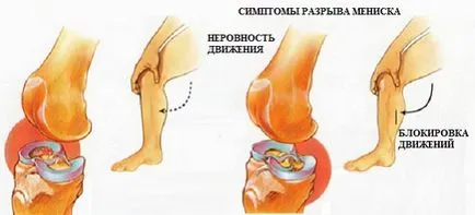 Повреда на менискуса на коляното симптоми и лечение, непоправим