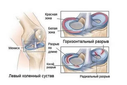 Повреда на менискуса на коляното симптоми и лечение, непоправим