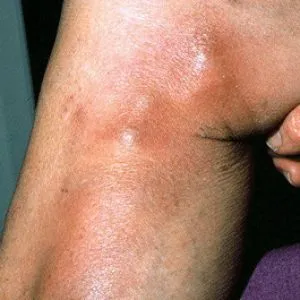 Okok thrombophlebitis, trombanet