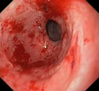 Készítmények kezelésére gastritis és a gyomorfekély, ogastrite