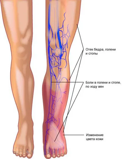 Okok thrombophlebitis, trombanet