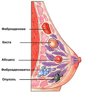 Мастит и гърдата се различава