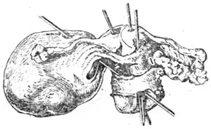 perforarea uterului în timpul avortului artificial