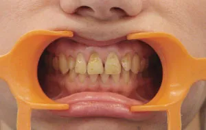Nyaki fogszuvasodást okoz, a megelőzés és a kezelés