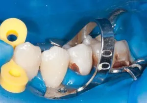 Маточната причинява зъбен кариес, превенция и лечение