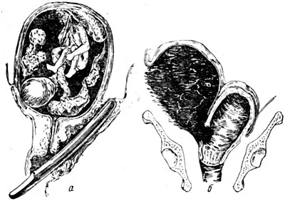 perforarea uterului în timpul avortului artificial