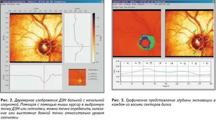 Utilizarea laserului tomografiei retiniene in diagnosticul de glaucom