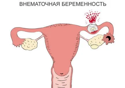 Psihomatika endometriózis